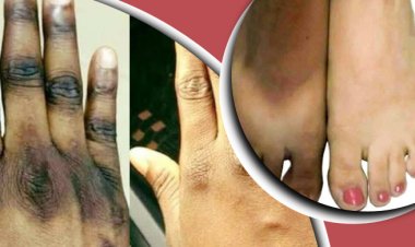 হাত-পায়ের কালো দাগ দূর করার উপায় কী?