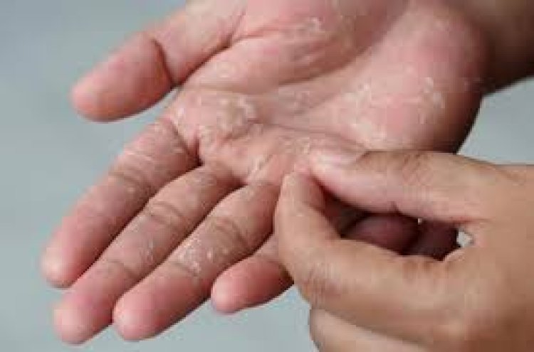 সাবান-জলের কারণে হাতের চামড়া উঠছে? ঘরোয়া সমাধান জানুন