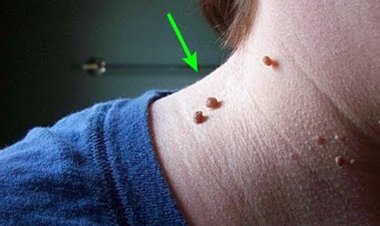 আঁচিলের কারণ ও প্রতিকার জানুন