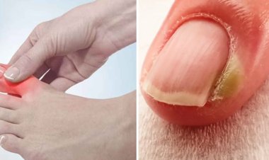 নখকুনি কেন হয়? ঘরোয়া উপায়ে যেভাবে সারাবেন