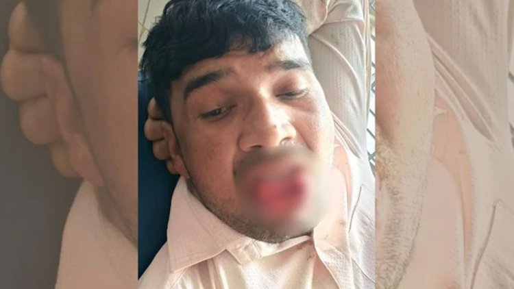 প্রেমিকাকে চুমু দিতে গিয়েই বিপদ-জিহ্বা ছিঁড়ে হাসপাতালে যুবক