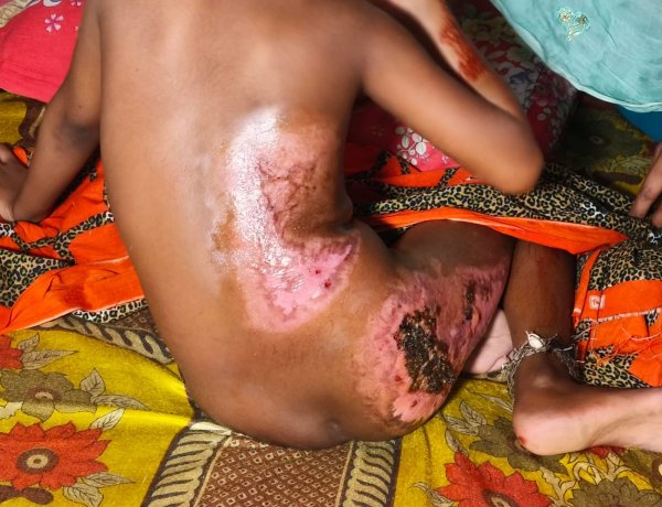 আগুনে পুড়ে ঝলসে গেল ৮ বছরের নূরীর স্বপ্ন 