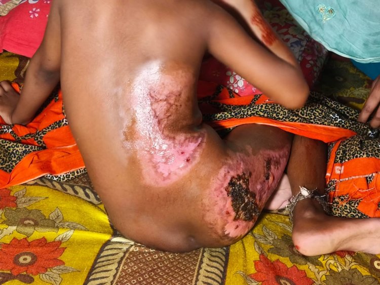 আগুনে পুড়ে ঝলসে গেল ৮ বছরের নূরীর স্বপ্ন 